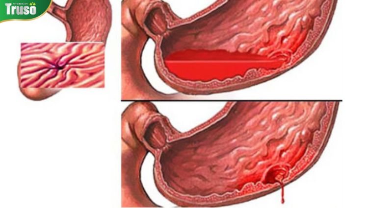 Ang pagdurugo ng tiyan ay kailangang gamutin agad dahil maaari itong magdulot ng panganib sa buhay.